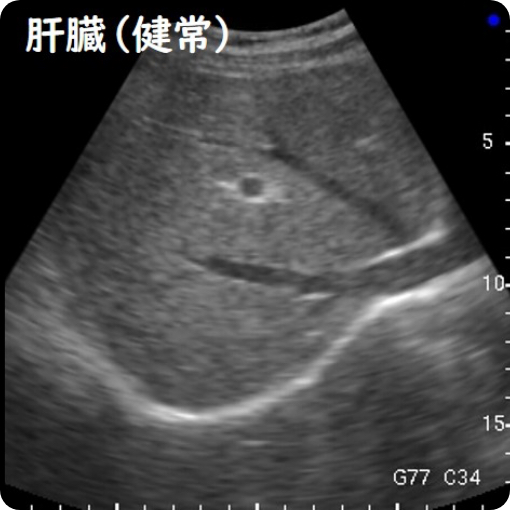 肝臓（健常）