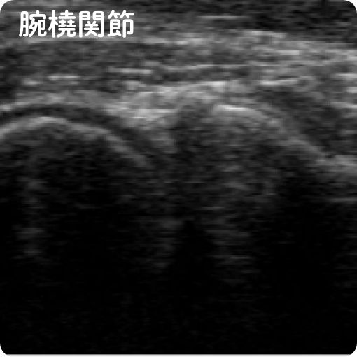 腕橈関節