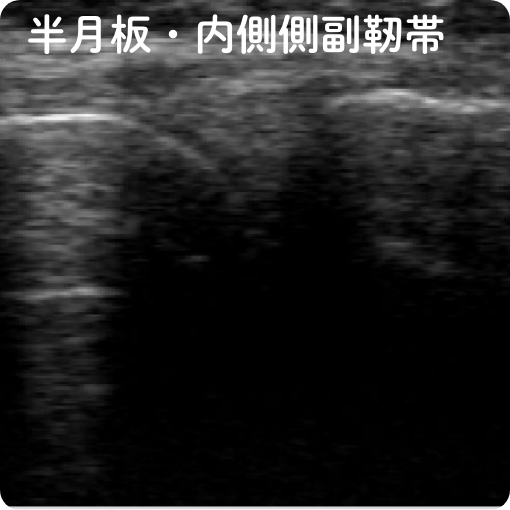 半月板・内側側副靭帯