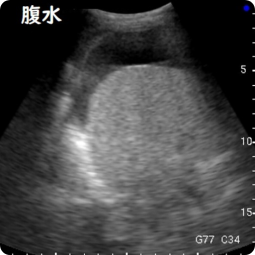 肝臓（転移性肝癌）