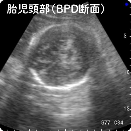 前立腺（肥大）