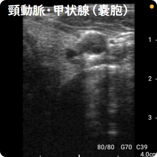 頸動脈・甲状腺（嚢胞）