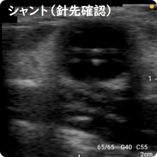 シャント（針先確認）