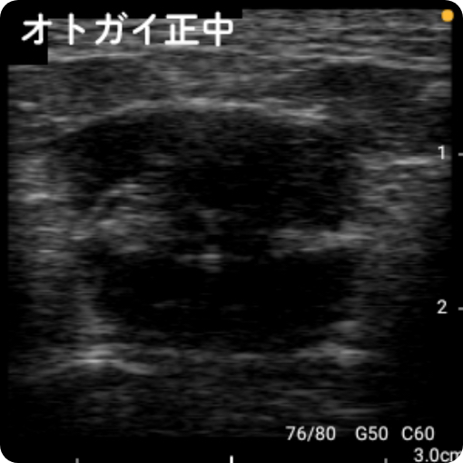 表情筋