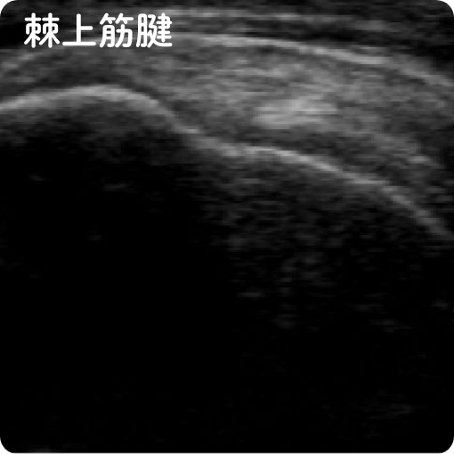 棘上筋腱