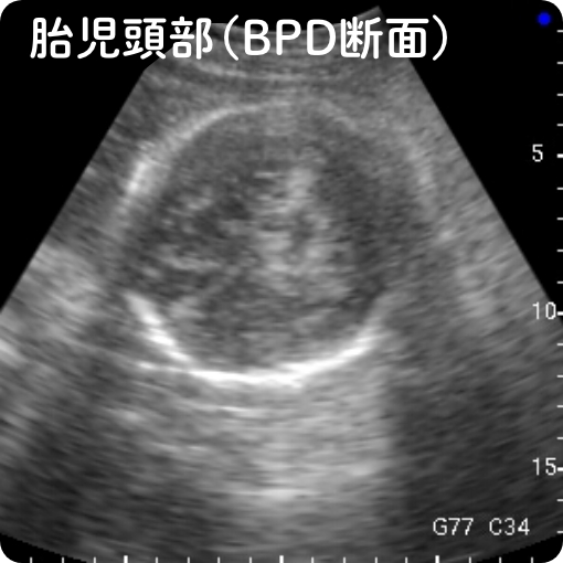 胎児腹部（BPD断面）